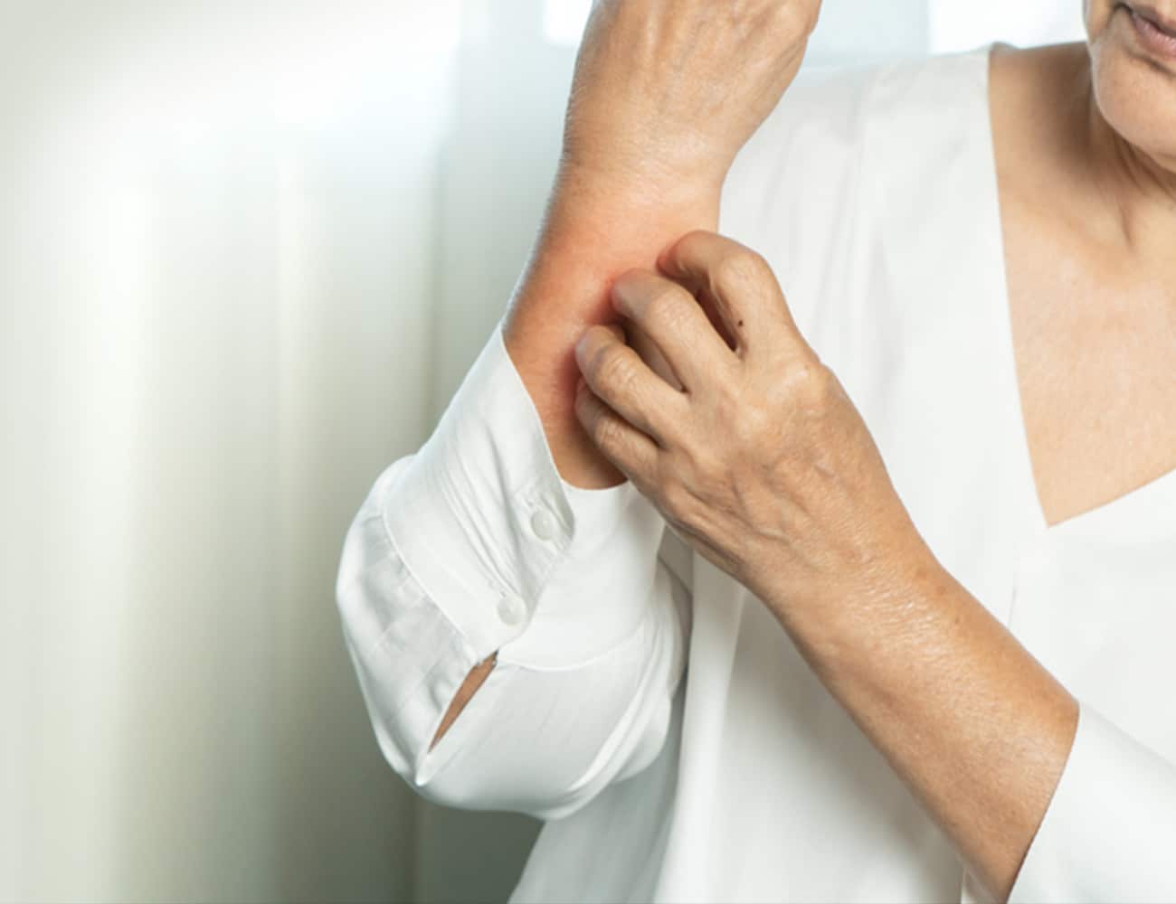 Hand scratching at eczema on arm