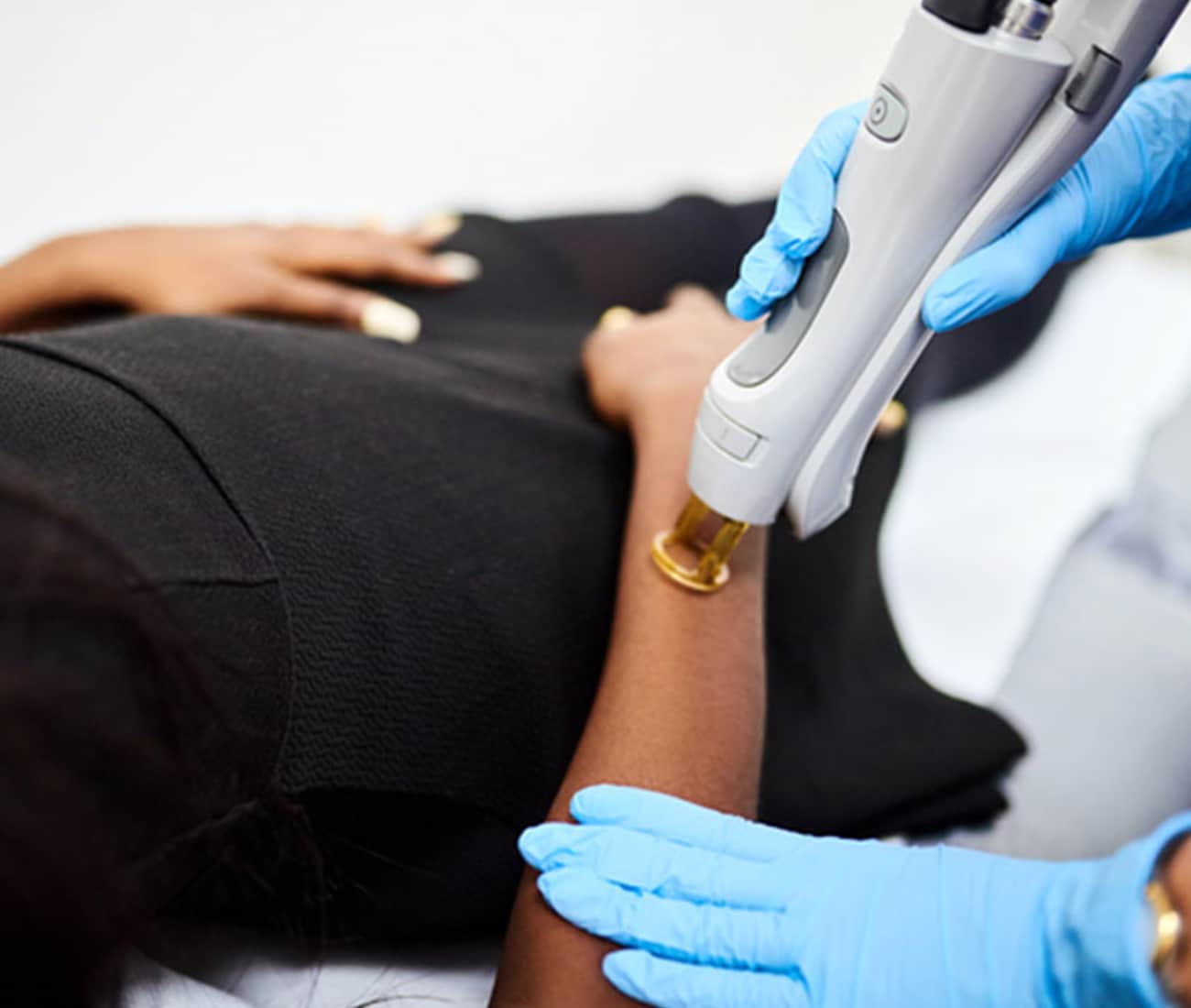 Woman receiving laser hair removal treatment on her arm