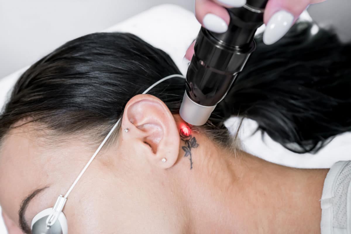 Picosure Tattoo Removal North Myrtle Beach SC Review RealSelf #61 Picosure Tattoo Removal North Myrtle Beach SC Review RealSelf