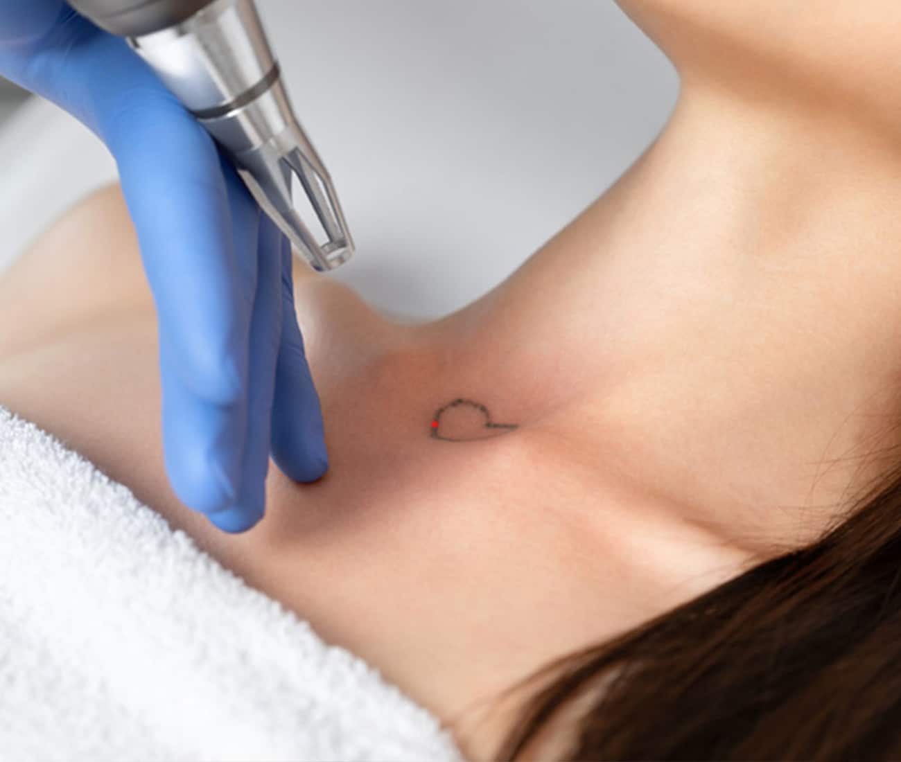 Patient getting heart tattoo removed on collarbone