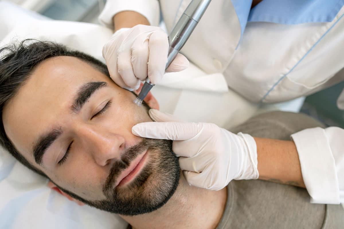 Patient receiving RF Microneedling