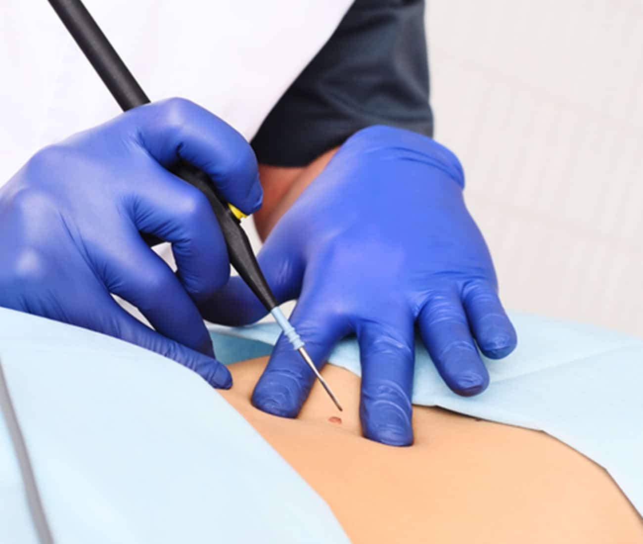 Doctor holding equipment to remove patients mole