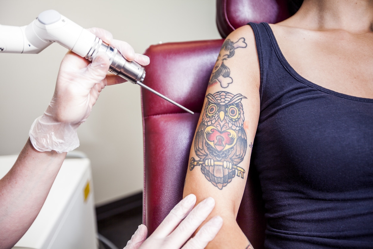 Laser Tattoo Removal FAQ: Top Questions - Pinnacle Dermatology